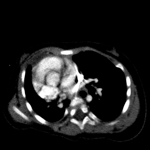 Aberrant left pulmonary artery (pulmonary sling) (Radiopaedia 42323-45435 Axial C+ CTPA 24).jpg