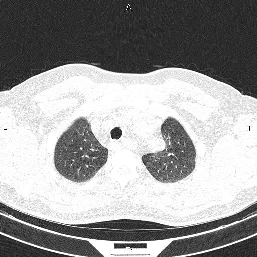 File:Aberrant right subclavian artery (Radiopaedia 87093-103354 Axial lung window 21).jpg