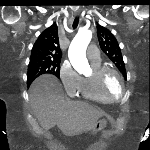 File:Aberrant right subclavian artery with Kommerell diverticulum (Radiopaedia 47982-52769 Coronal C+ arterial phase 23).png