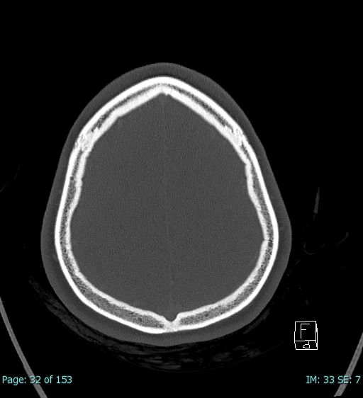 Abscess of the pinna (Radiopaedia 68868-78598 Axial bone window 6).jpg