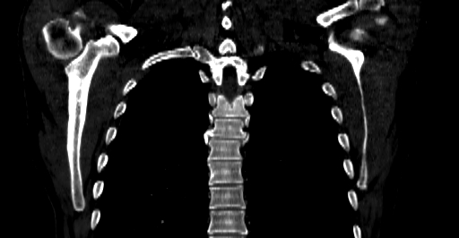 Accesory rib joint (Radiopaedia 71987-82452 Coronal bone window 42).jpg