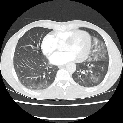 Accessory left horizontal fissure with lingular pneumonia (Radiopaedia 53763-59843 Axial lung window 37).jpg