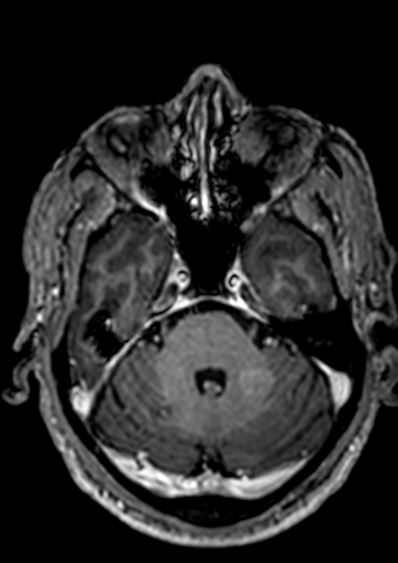 File:Accessory middle cerebral artery (Radiopaedia 73114-83828 Axial T1 C+ 115).jpg
