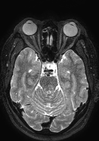 Accessory middle cerebral artery (Radiopaedia 73114-83828 Axial T2 132).jpg