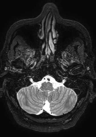 Accessory middle cerebral artery (Radiopaedia 73114-83828 Axial T2 193).jpg