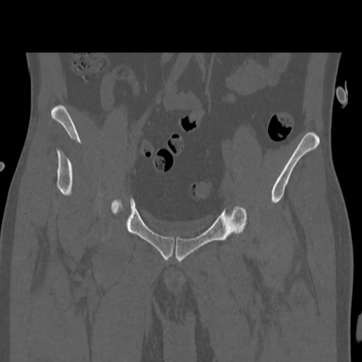 Acetabular and ilial fractures (Radiopaedia 59084-66378 Coronal bone window 16).jpg