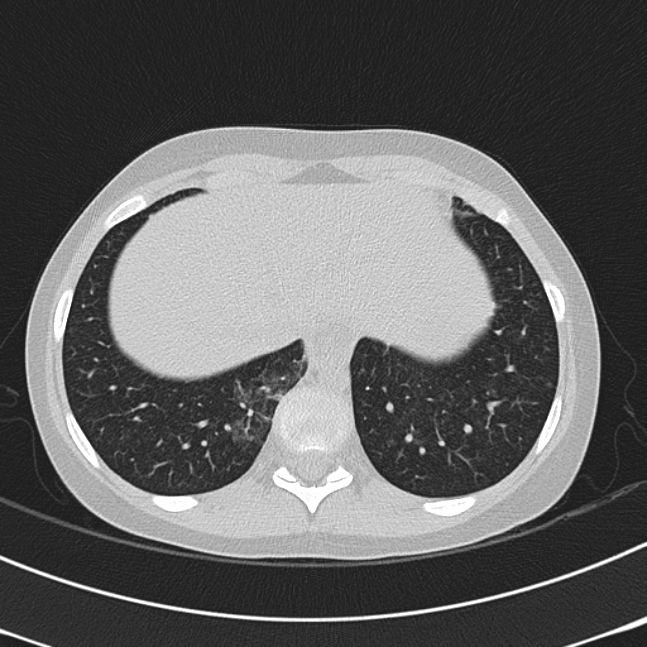 Achalasia (Radiopaedia 14946-14878 Axial lung window 67).jpg