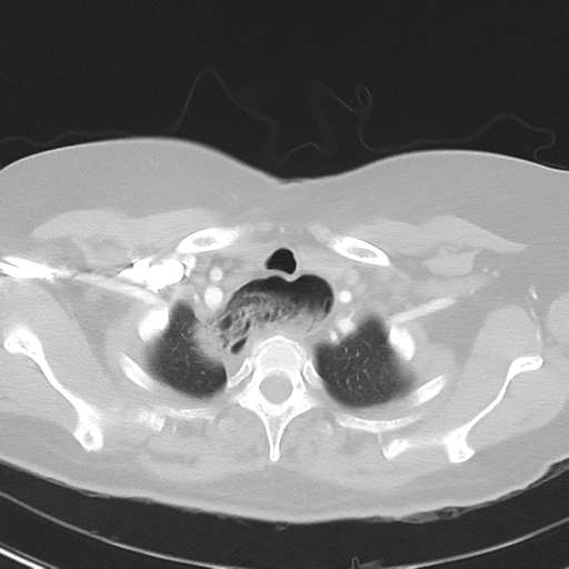 File:Achalasia (Radiopaedia 47147-51685 Axial lung window 7).png
