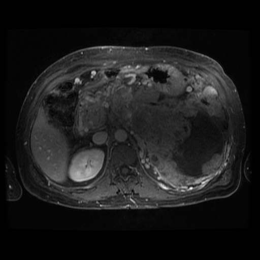 Acinar cell carcinoma of the pancreas (Radiopaedia 75442-86668 Axial T1 C+ fat sat 66).jpg