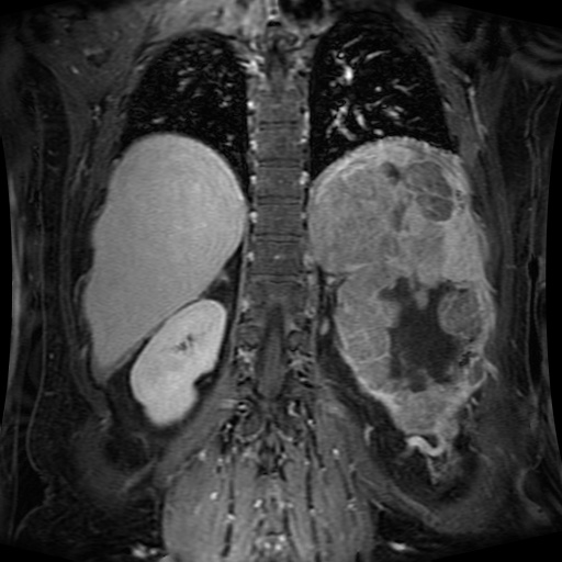 File:Acinar cell carcinoma of the pancreas (Radiopaedia 75442-86668 Coronal T1 C+ fat sat 55).jpg