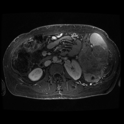 Acinar cell carcinoma of the pancreas (Radiopaedia 75442-86668 D 29).jpg