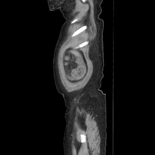 Acinar cell carcinoma of the pancreas (Radiopaedia 75442-86669 Sagittal C+ portal venous phase 28).jpg