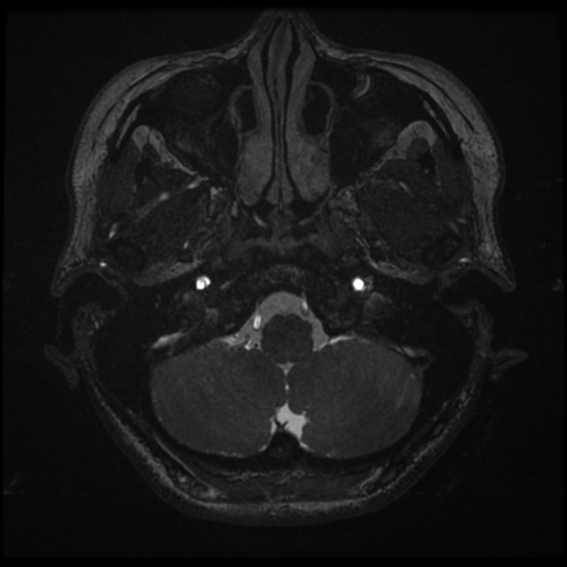 Acoustic neuroma (Radiopaedia 34049-35283 Axial 12).png