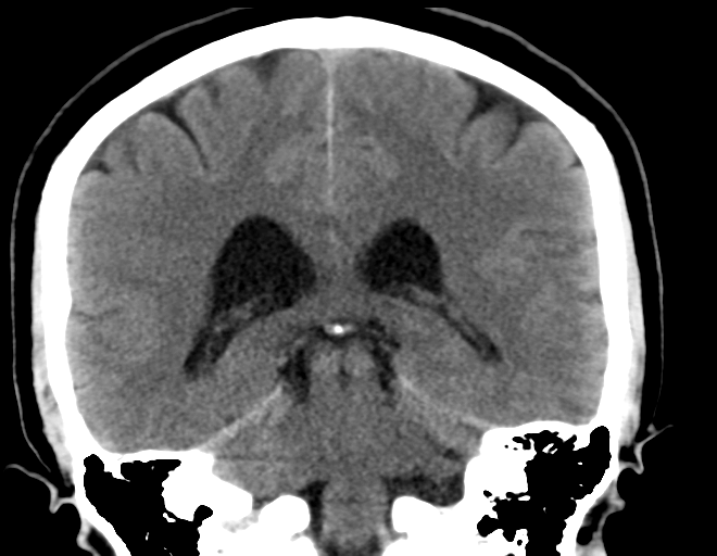 File:Acoustic schwannoma (Radiopaedia 33045-34065 Coronal non-contrast 28).png