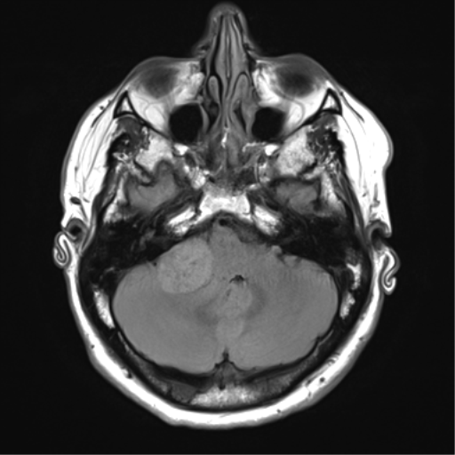 File:Acoustic schwannoma (Radiopaedia 50846-56358 Axial FLAIR 8).png