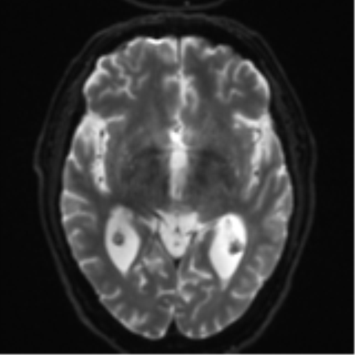 Acoustic schwannoma (Radiopaedia 55729-62281 E 12).png