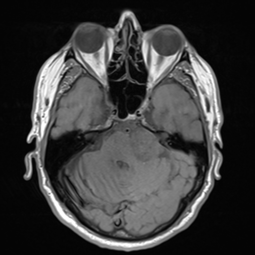 File:Acoustic schwannoma (Radiopaedia 55729-62281 T1 9).png