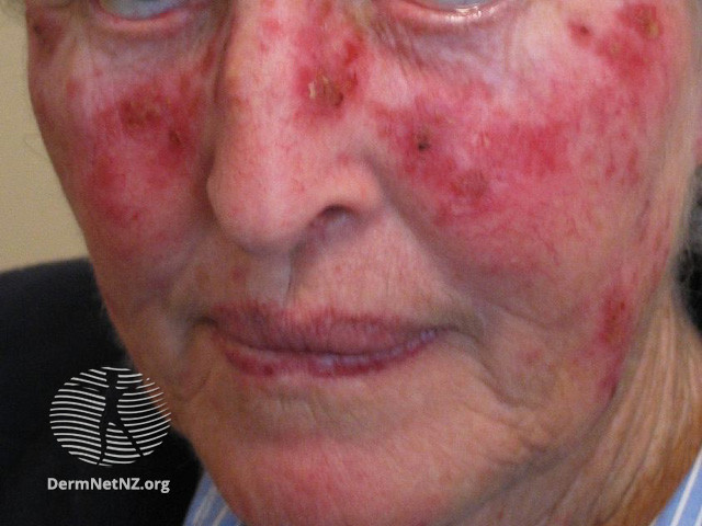 File:Actinic Keratoses treated with imiquimod (DermNet NZ lesions-ak-imiquimod-3740).jpg