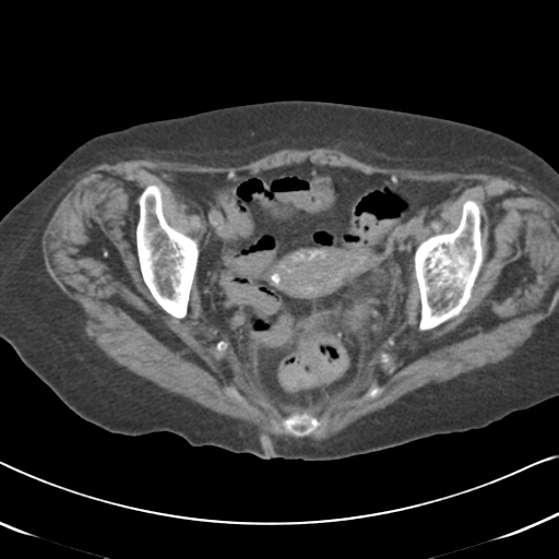 File:Active bleeding from duodenal ulcer with embolization (Radiopaedia 34216-35481 Axial non-contrast 59).png