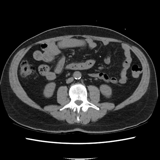 Active colonic bleed on CT (Radiopaedia 49765-55025 Axial non-contrast 41).jpg