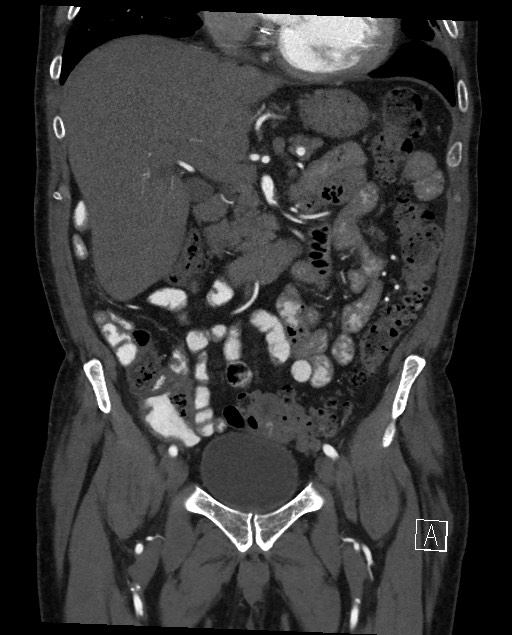 Active lower gastrointestinal bleeding - diverticular (Radiopaedia 61203-69106 Coronal C+ arterial phase 56).jpg