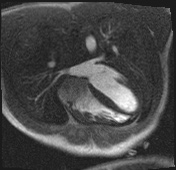 Active right ventricular cardiac sarcoidosis (Radiopaedia 55596-62100 Axial Dynamic perfusion scan MOCO 65).jpg