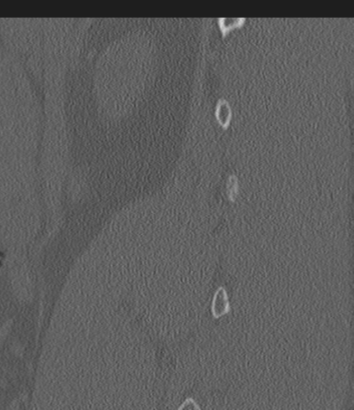 Acute L1 burst compression fracture (Radiopaedia 34430-35755 Sagittal bone window 54).png