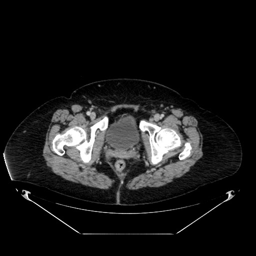 Acute appendicitis, heterotaxy syndrome (Radiopaedia 66884-76202 Axial C+ portal venous phase 126).jpg