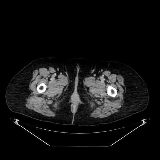 Acute appendicitis, heterotaxy syndrome (Radiopaedia 66884-76202 Axial C+ portal venous phase 145).jpg