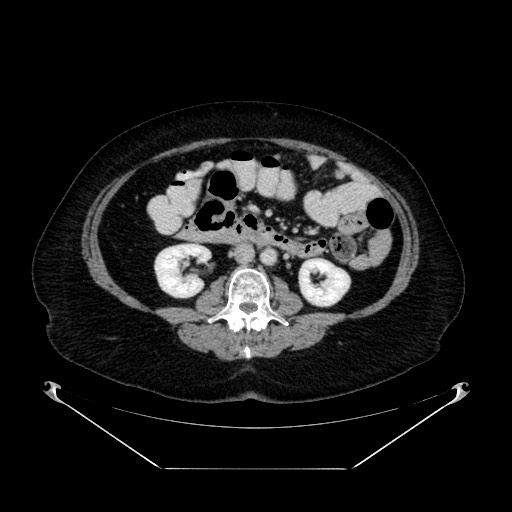 Acute appendicitis, heterotaxy syndrome (Radiopaedia 66884-76202 Axial C+ portal venous phase 63).jpg