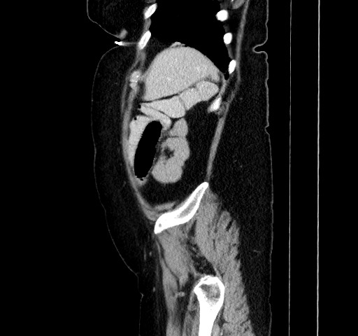 File:Acute appendicitis, heterotaxy syndrome (Radiopaedia 66884-76202 Sagittal C+ portal venous phase 110).jpg