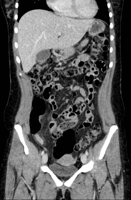 Acute appendicitis (Radiopaedia 22892-22918 Coronal C+ portal venous phase 15).png