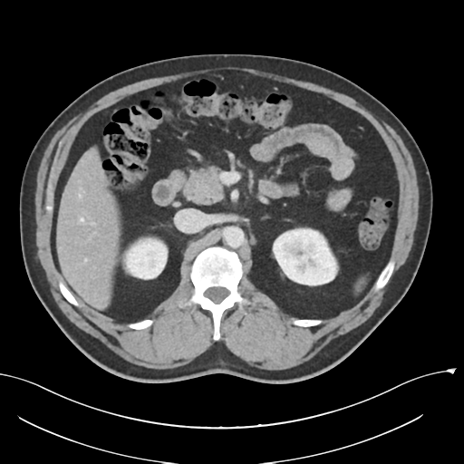 Acute appendicitis (Radiopaedia 36611-38177 Axial C+ portal venous phase 35).png