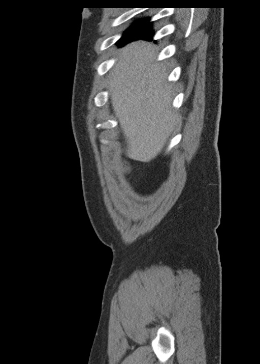 Acute appendicitis (Radiopaedia 48511-53463 Sagittal C+ portal venous phase 23).jpg