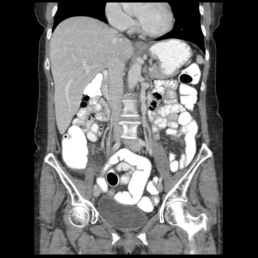 Acute appendicitis (Radiopaedia 52672-58589 Coronal C+ portal venous phase 51).jpg