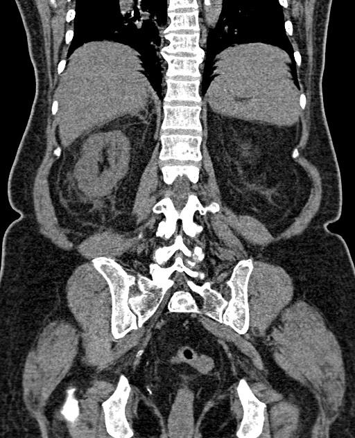 Acute appendicitis (Radiopaedia 58627-65818 Coronal non-contrast 51).jpg