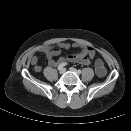 Acute appendicitis (Radiopaedia 66513-75790 Axial C+ portal venous phase 59).jpg