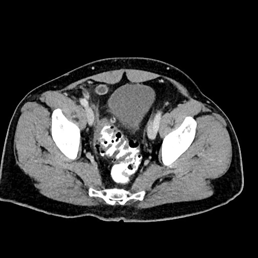 Acute appendicitis (Radiopaedia 77016-88960 Axial C+ portal venous phase 123).jpg