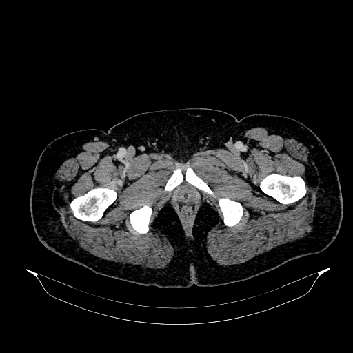 Acute appendicitis (Radiopaedia 79950-93224 Axial C+ portal venous phase 105).jpg