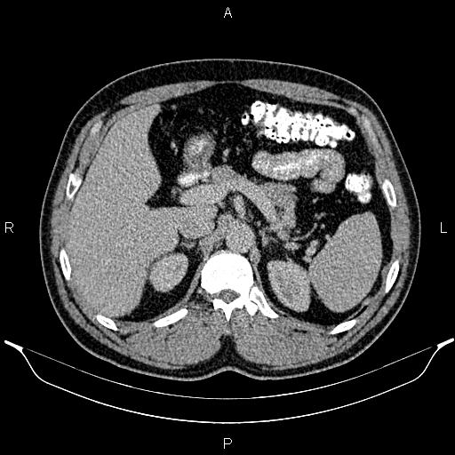 File:Acute appendicitis (Radiopaedia 84780-100240 Axial C+ portal venous phase 30).jpg