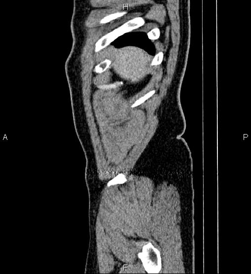 Acute appendicitis (Radiopaedia 84780-100240 Sagittal C+ portal venous phase 4).jpg