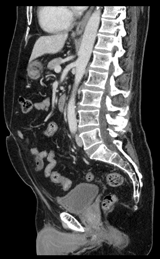Acute appendicitis - large appendicoliths (Radiopaedia 61805-69820 Sagittal C+ portal venous phase 55).jpg