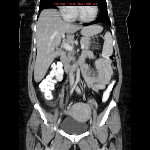 Acute appendicitis complicated by ovarian vein thrombophlebitis (Radiopaedia 16172-15851 Coronal C+ portal venous phase 39).jpg