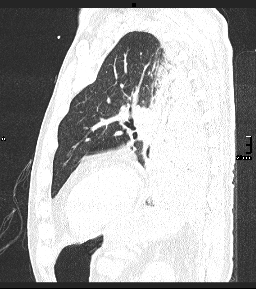 Acute aspiration pneumonitis (Radiopaedia 55642-62166 Sagittal lung window 44).jpg