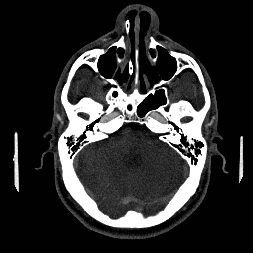 Acute basilar artery occlusion (Radiopaedia 43582-46985 Axial C+ arterial phase 69).jpg