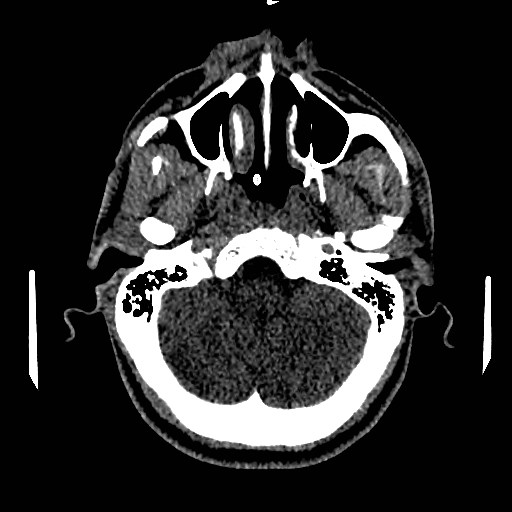 Acute basilar artery occlusion (Radiopaedia 43582-46985 Axial non-contrast 44).jpg