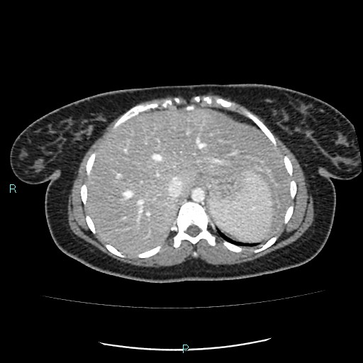 File:Acute bilateral pyelonephritis (Radiopaedia 37146-38881 Axial C+ portal venous phase 15).jpg