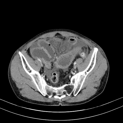 Acute bowel ischemia (Radiopaedia 87695-104114 Axial C+ portal venous phase 69).jpg