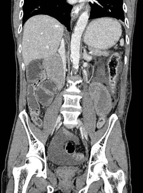Acute bowel ischemia (Radiopaedia 87695-104114 Coronal C+ portal venous phase 227).jpg