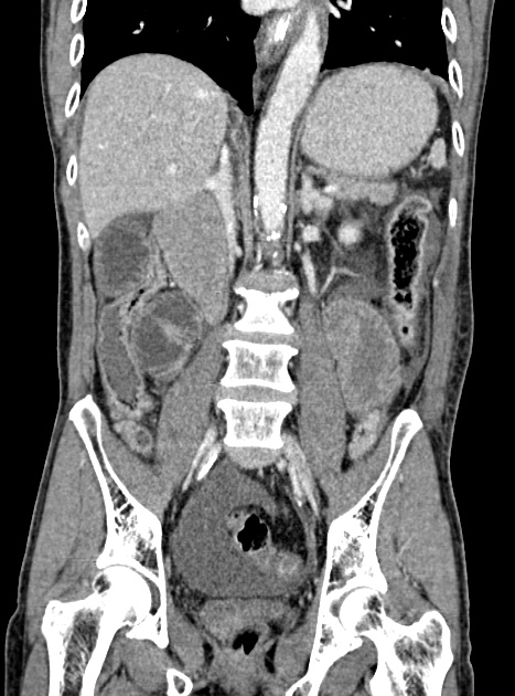 Acute bowel ischemia (Radiopaedia 87695-104114 Coronal C+ portal venous phase 230).jpg